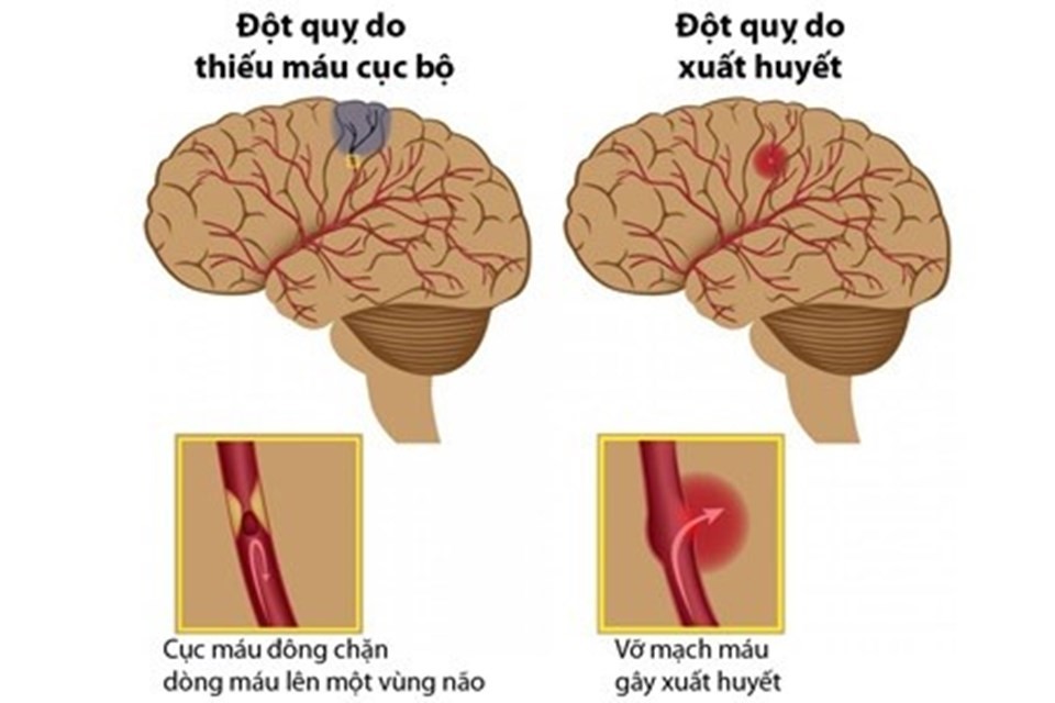 Phân biệt đột quỵ nhồi máu não và đột quỵ xuất huyết não như thế nào?