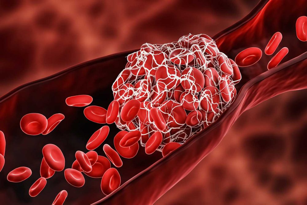 Những ai cần tầm soát cục máu đông – nguy cơ đột quỵ hậu COVID-19?