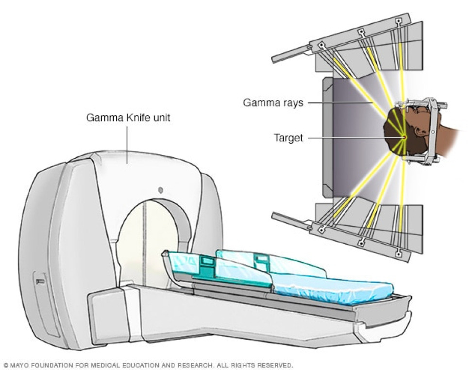 Xạ phẫu Gamma Knife, khi nào được áp dụng?