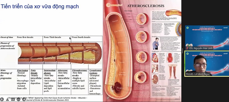 Hình ảnh quá trình tiến triển của xơ vữa động mạch