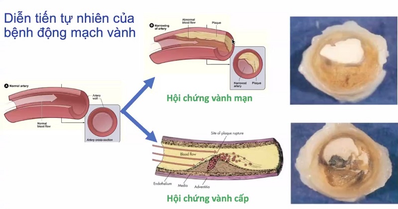 Bệnh mạch vành diễn tiến nặng dần theo thời gian, khiến cho cơ tim hoạt động nhiều hơn và trở nên suy yếu dần, dẫn đến tình trạng suy tim và loạn nhịp tim.