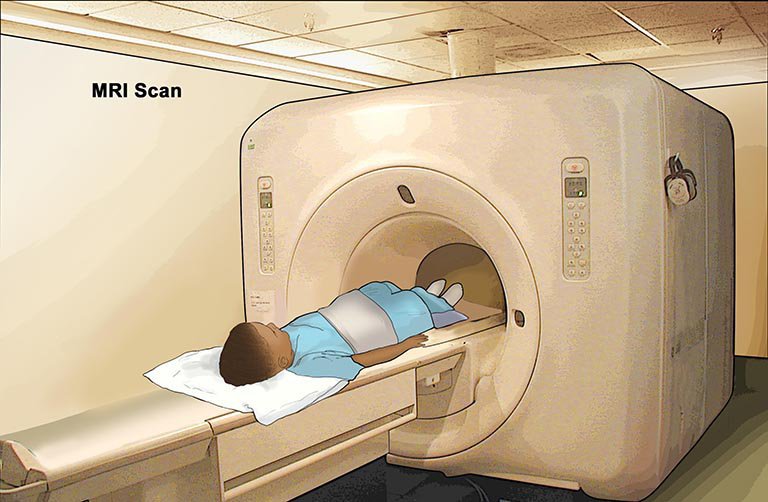 Chụp MRI là một trong những phương pháp để chẩn đoán đột quỵ chính xác nhất