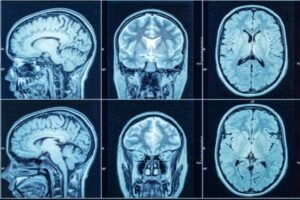 Chụp CT liệu có phát hiện được nguy cơ đột quỵ?