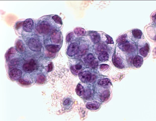 Adenomas
