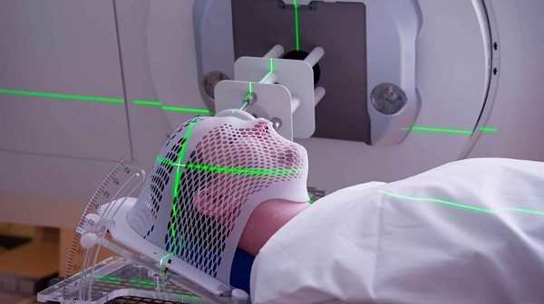 Xạ trị ung thư là gì và tác dụng phụ thế nào?