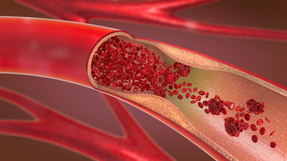 Bệnh mạch máu: Phân loại, nguyên nhân và cách điều trị
