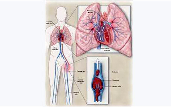 Khi nào thuyên tắc huyết khối tĩnh mạch sẽ gây ra thuyên tắc phổi?