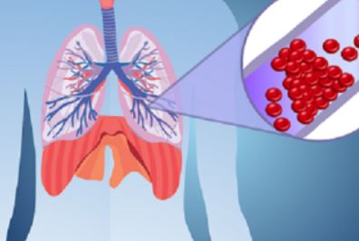 Người bệnh thuyên tắc phổi cần điều trị dự phòng bao lâu?