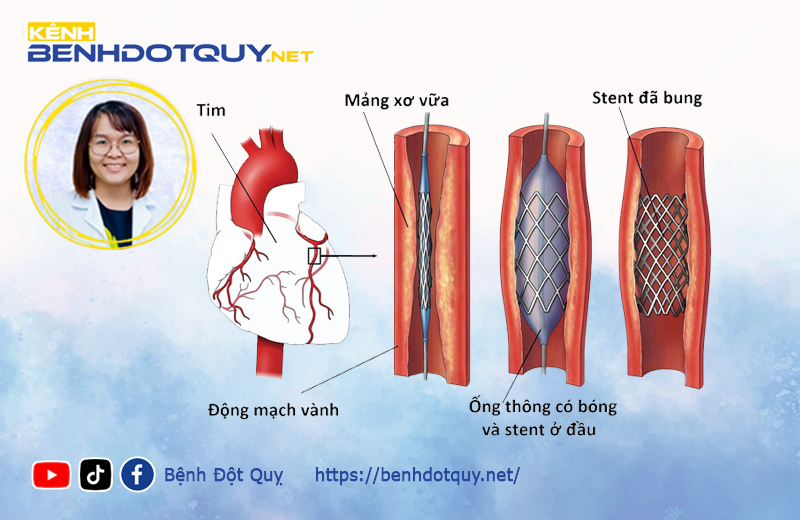 Sau khi đặt stent mạch vành, bệnh nhân cần làm gì để tránh nguy cơ tắc stent?