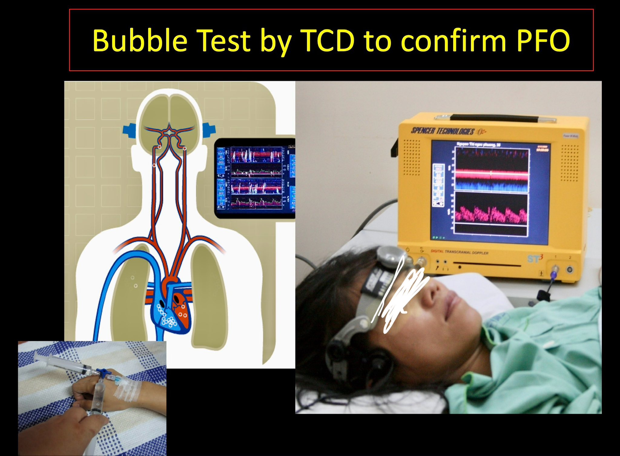 PGS Nguyễn Huy Thắng: Khi nào cần tầm soát tồn tại lỗ bầu dục (PFO) để dự phòng đột quỵ?