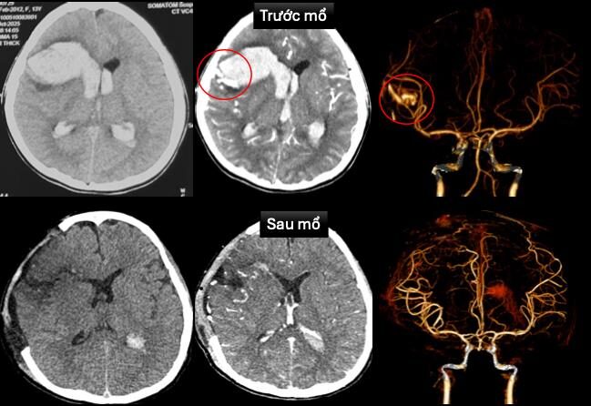 Cứu sống bé gái 13 tuổi hôn mê do vỡ mạch máu não trên nền bệnh tim hiếm gặp