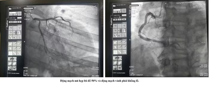 Hồi sinh sự sống cho người bị nhồi máu cơ tim cấp trong đêm