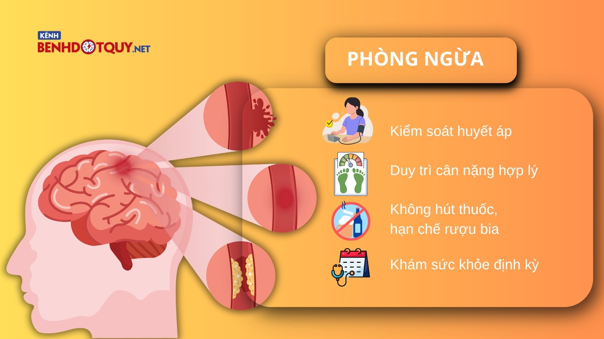 Hai dạng đột quỵ nguy hiểm nhất cần nhận biết sớm