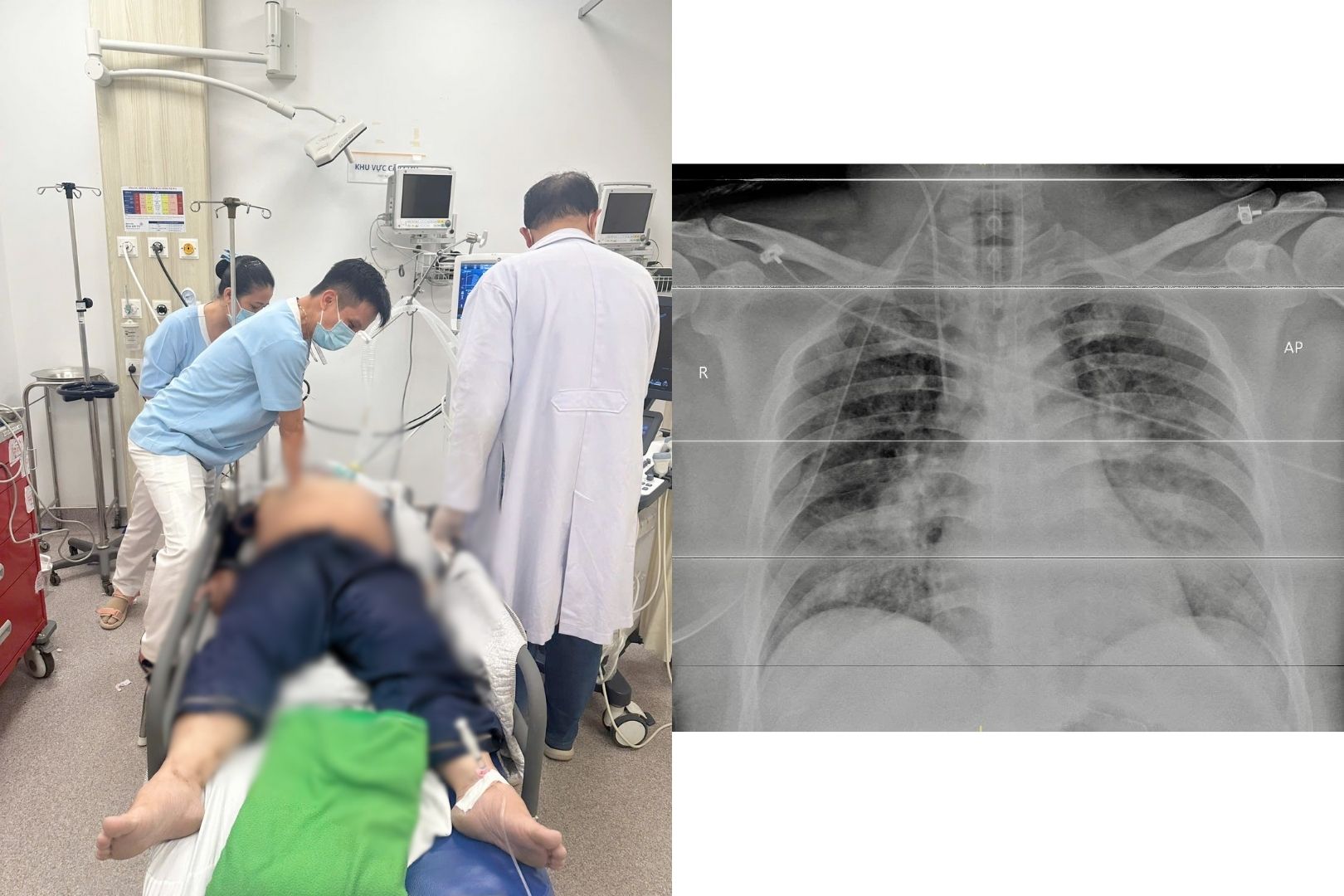 Ngưng tim vì chủ quan với hen phế quản