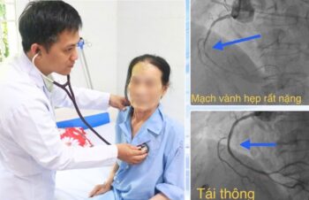 https://benhdotquy.net/cuu-song-cu-ba-85-tuoi-nhoi-mau-co-tim-cap-ton-thuong-ca-3-nhanh-mach-vanh/